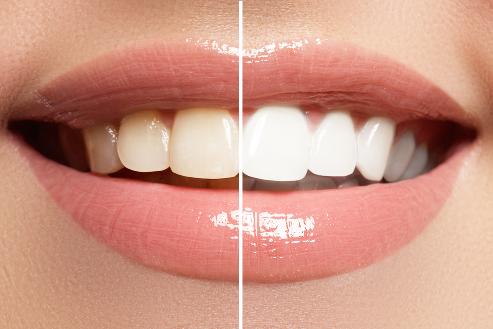 Avadent Bleaching.jpg