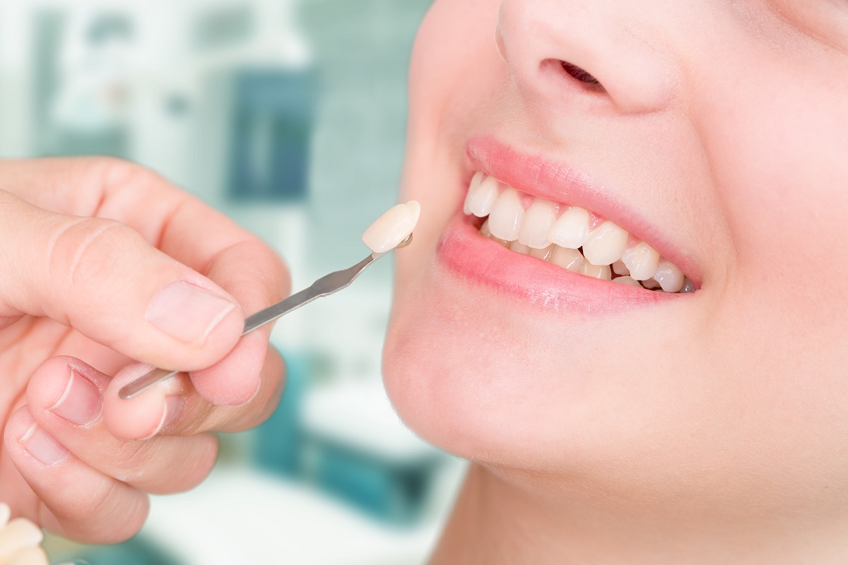Veneers Anwendung.jpg